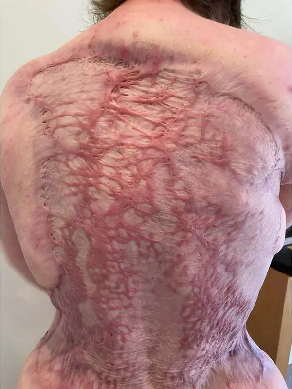 Beatriz com queimaduras